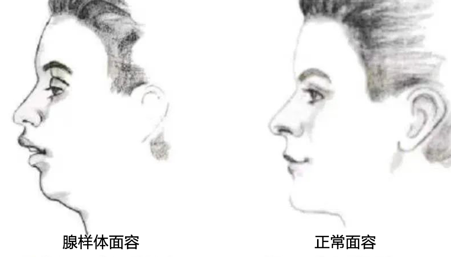 01 什么是腺樣體面容？.png