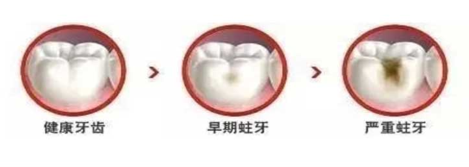 06 補牙為什么要趁早？.png