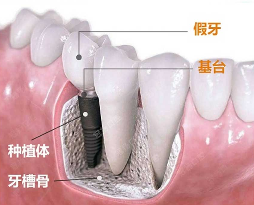 01 為啥現(xiàn)在缺牙都做種植牙？.png